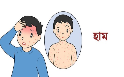 রংপুরে হামের উপসর্গ নিয়ে আরও এক শিশুর মৃত্যু, ৬ মাসে প্রাণহানি ৫২